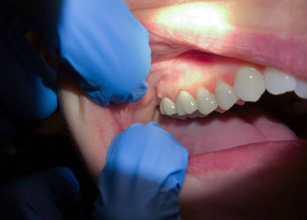 Best Emergency Denture Repair in Bel Air North, MD