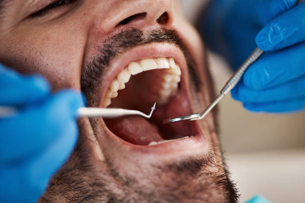 Best Emergency Treatment for Dental Infections or Abscesses in Bel Air North, MD