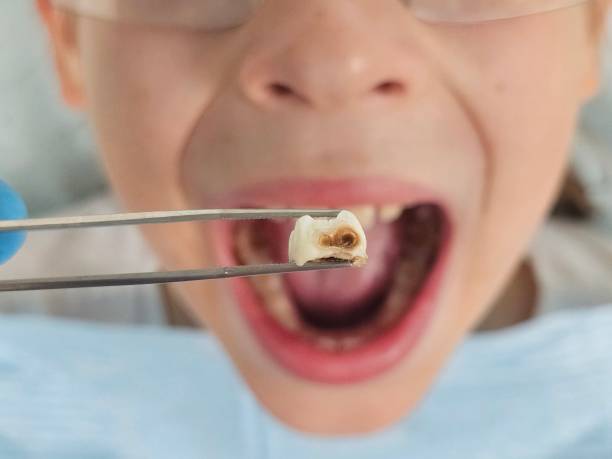 Best Emergency Dental Care for Broken or Chipped Teeth in Bel Air North, MD